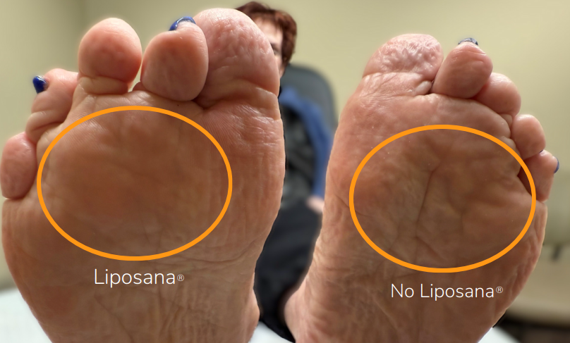 Liposana Before and After Comparison